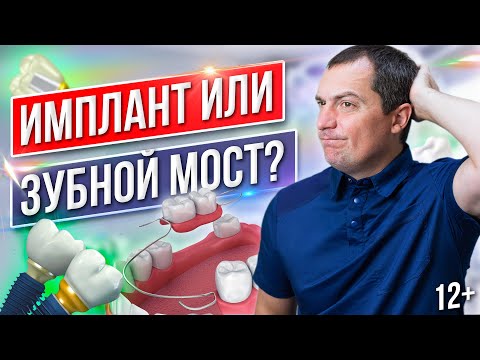 Видео: ИМПЛАНТЫ ЗУБОВ или ЗУБНОЙ МОСТ - что лучше выбрать? Имплантация зубов