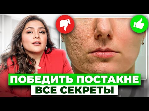 Видео: Как избавиться от пятен и рубцов от прыщей? / ТОП бюджетных средств, которые реально работают!