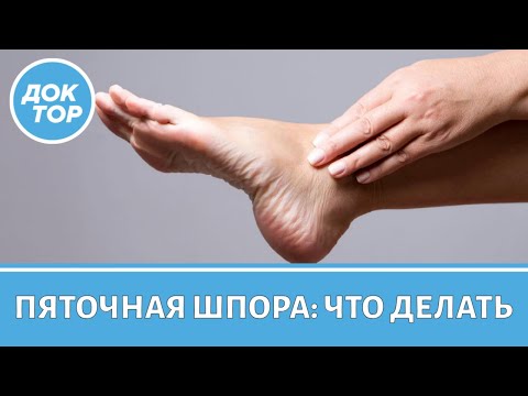 Видео: Что делать, если у вас пяточная шпора