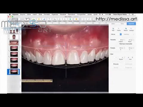 Видео: Керамические виниры. Цифровой дизайн улыбки. (DSD- digital smile design)
