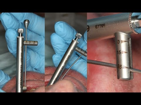Видео: Имплантоводы — как пользоваться динамометрическим ключом и имплантоводами Straumann