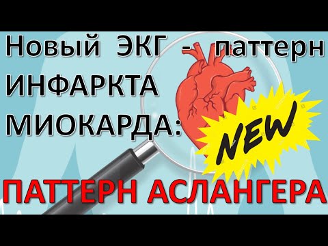 Видео: ЭКГ при Инфарктах миокарда: Паттерн Аслангера (Aslanger's Pattern)