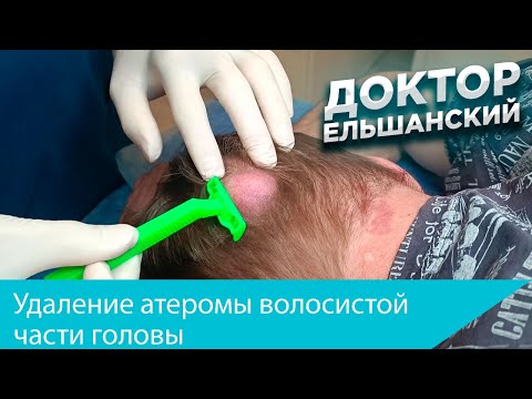 Видео: Удаление атеромы волосистой части головы. Removal of atheroma of the head