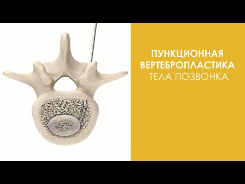 Видео: Пункционная вертебропластика тела позвонка