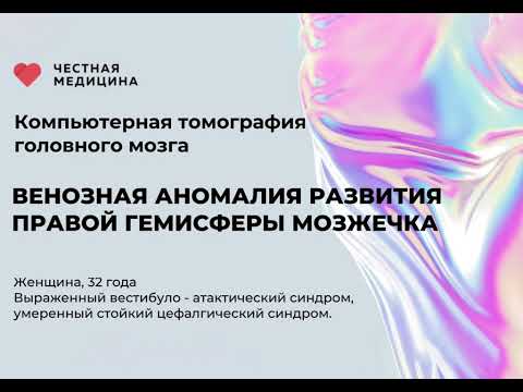 Видео: КТ головного мозга"Венозная аномалия развития правой гемисферы мозжечка"от компании Честная Медицина