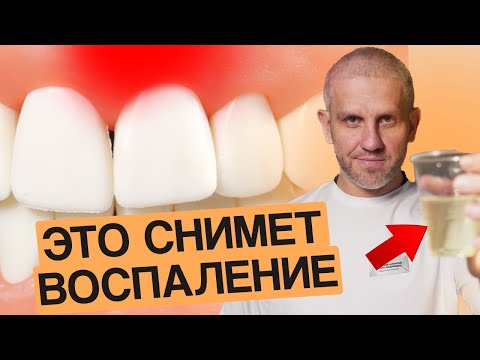 Видео: Что делать если ВОСПАЛИЛАСЬ десна? Легкий СПОСОБ снять воспаление