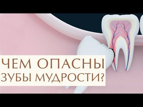 Видео: 🤔 Для чего нужны зубы мудрости, стоит или нет их удалять. Удалять или нет зуб мудрости. 12+