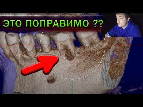 Видео: Периодонтит - вторичная эндодонтия и деструкция в бифуркации - перелечивание  корневых каналов зуба