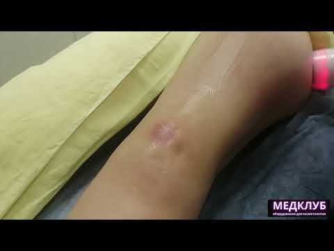 Видео: Вакуумный массаж с RF часть урока №7. Практика.