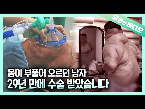 Видео: (Обновление) Его жизнь после удаления 7 кг липомы