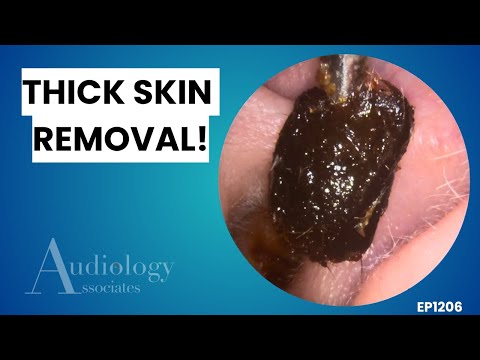 Видео: Подборка экстремального удаления ушной серы | 4 способа глубокой очистки ушей! - EP1206