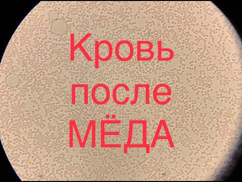 Видео: Кровь после мёда