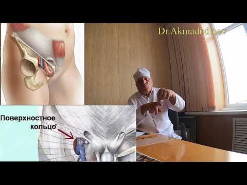 Видео: Брюшная стенка. Грыжи. Часть 4. Проф. Ахмадудинов М.Г.