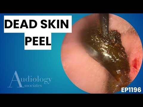 Видео: Экстремальное удаление ушной серы | Удаление омертвевшей кожи и глинистого налёта - EP1196