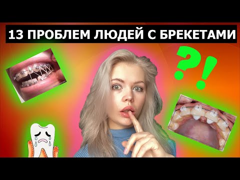 Видео: БРЕКЕТЫ. ПРОБЛЕМЫ С БРЕКЕТАМИ. НЕ УСТАНАВЛИВАЙТЕ, ПОКА НЕ ПОСМОТРИТЕ