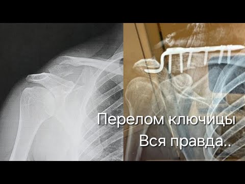 Видео: Перелом ключицы, вся правда о переломе и реабилитации.
