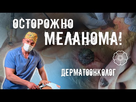 Видео: ОСТОРОЖНО МЕЛАНОМА! ДЕРМАТООНКОЛОГ