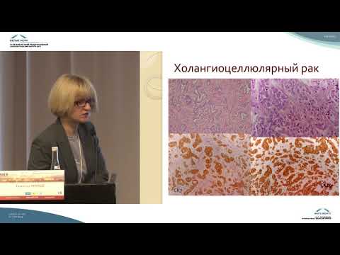 Видео: Морфологическая диагностика гепатоцеллюлярного и холангиоцеллюлярного раков