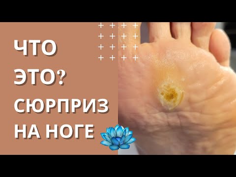 Видео: Что это? Стержневая мозоль на ноге или бородавка на стопе.