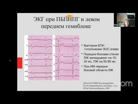 Видео: Особенности сердечной ресинхронизирующей терапии. Показания, критерии диагностики