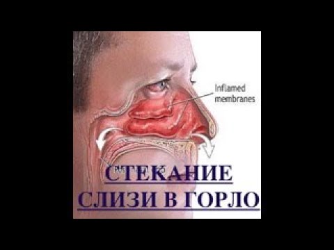 Видео: Почему стекает слизь по горлу? Лечение синдрома постназального затекания.