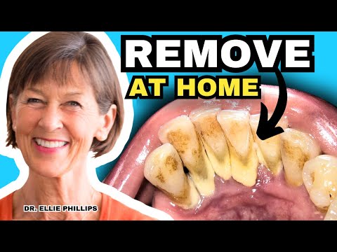 Видео: Удаление зубного камня в домашних условиях и как предотвратить его появление