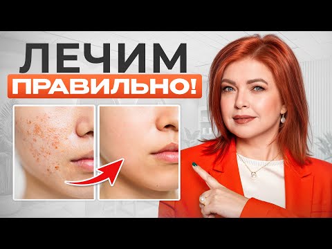 Видео: ПИГМЕНТАЦИЯ — это НЕ ПРИГОВОР! / Как избавиться от пятен РАЗ и НАВСЕГДА?