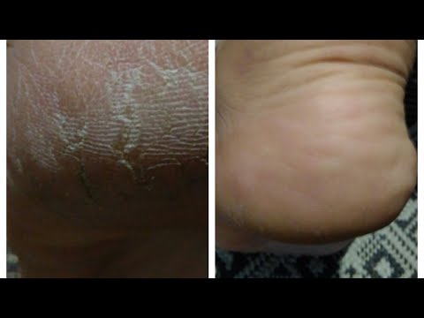 Видео: ТРЕЩИНЫ на пятках. Как убрать  трещины на пятках за 3 дня!