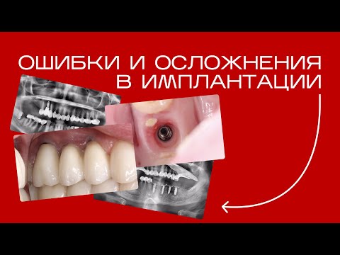 Видео: ОШИБКИ И ОСЛОЖНЕНИЯ В ИМПЛАНТАЦИИ. Игорь Налиткин