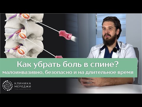 Видео: Радиочастотная денервация суставов позвоночника – эффективный метод контроля боли в спине