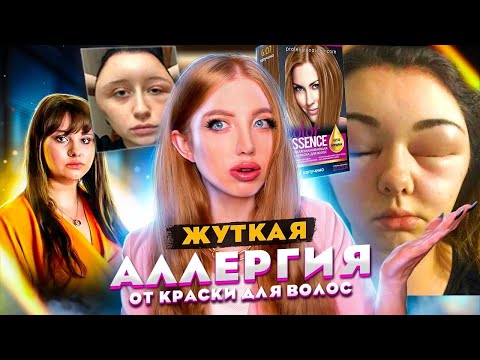 Видео: РЕАКЦИЯ НА ОПУХЛА ГОЛОВА ОТ ДЕШЕВОЙ КРАСКИ ДЛЯ ВОЛОС!!! РЕАКЦИЯ ПАРИКМАХЕРА НА ЖУТКОЕ ОКРАШИВАНИЕ