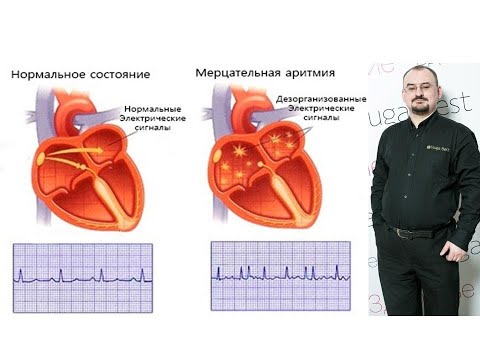 Видео: Мерцательная аритмия – проявление и лечение