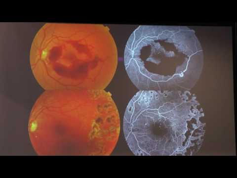 Видео: Лазерная коагуляция сетчатки при диабетической ретинопатии