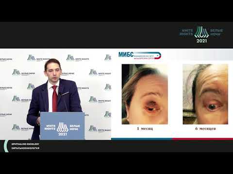 Видео: Опыт применения протонной терапии в лечении у пациентов с меланомой глаза (Воробьев Н.А.)