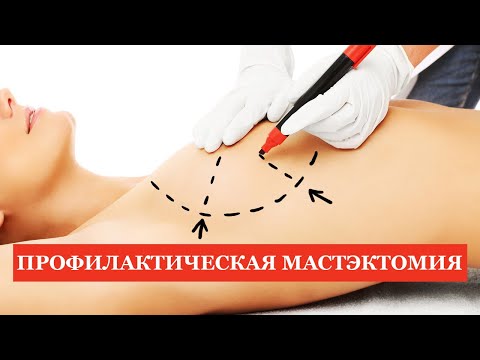 Видео: Профилактическая мастэктомия. Фиброаденомы. Внутрипротоковые папилломы.