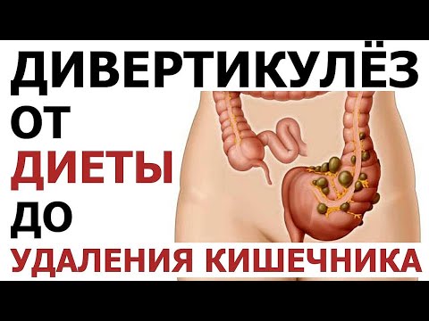 Видео: Что такое дивертикулы кишечника. Дивертикулез и дивертикулит. Судьба пациента с дивертикулёзом.