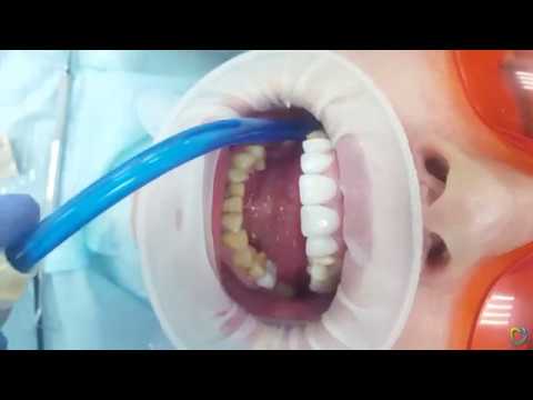 Видео: Установка циркониевых коронок (в клинике «Институт здоровья зубов»)