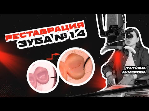 Видео: Реставрация зуба 1.4 - Татьяна Ахмерова | RestART
