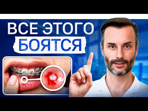 Видео: БРЕКЕТЫ и ЭЛАЙНЕРЫ – самые страшные опасения: порвать щеку, сломать брекеты...
