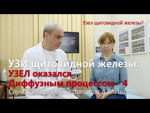 Видео: УЗИ щитовидной: Узел оказался Диффузным процессом! Пункция и Биопсия не нужны! /// Доктор Ушаков