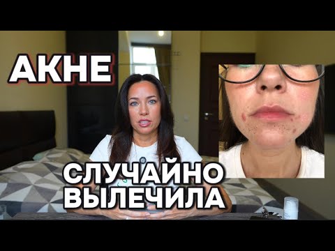 Видео: КАК Я СЛУЧАЙНО ИЗБАВИЛАСЬ ОТ ПРЫЩЕЙ!