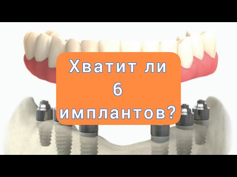 Видео: Протезирование на 6 ИМПЛАНТАХ. Несъемный протез на 6 имплантах.