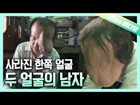 Видео: (Гл.1) Мужчина с гигантской опухолью на лице и его 40 лет