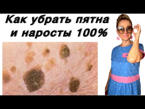 Видео: 🟢 Как избавиться от Старческих пятен и Наростов на теле…. Кожа будет гладкой… убери это средство