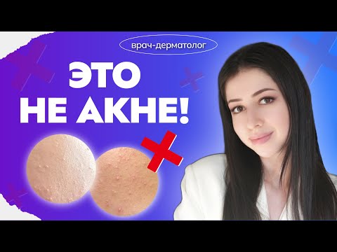 Видео: Это НЕ акне! Малассезия-фолликулит: симптомы и лечение. 