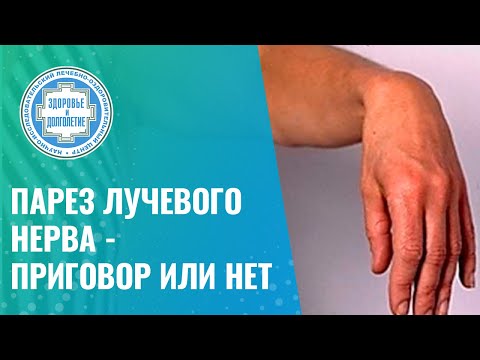 Видео: ✍️ Парез лучевого нерва - приговор или нет