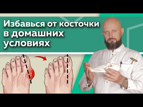 Видео: Как избавиться от шишки на ноге? / Эффективные упражнения для восстановления суставов