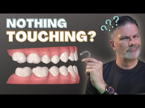 Видео: Как понять скачок прикуса в программе ClinCheck для прозрачных элайнеров Invisalign?