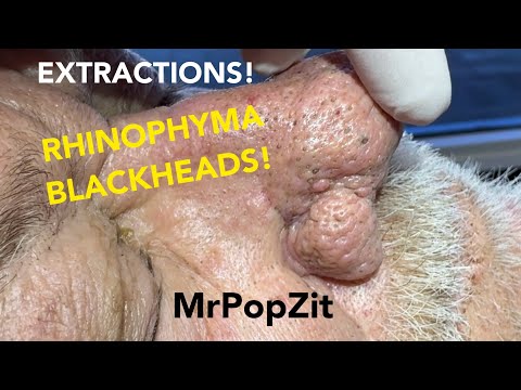 Видео: Посмотрите на черную точку, которая ПОЧТИ победила MrPopZit! Вы когда-нибудь видели черную точку ...