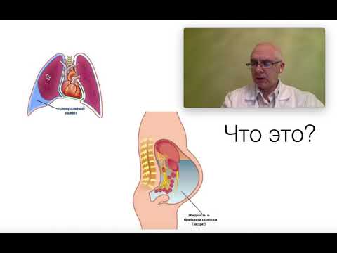 Видео: Асцит, Плеврит, как помочь онкологическому больному.